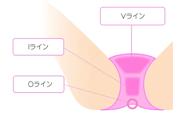 Iラインの場所を示すイラスト